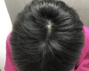 AGA治療前　25歳男性　頭頂部薄毛　京都院