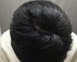 AGA治療7ヶ月後 47歳男性 頭頂部改善 京都院