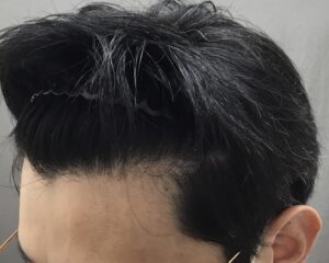 AGA治療7ヶ月後 47歳男性 生え際改善 京都院