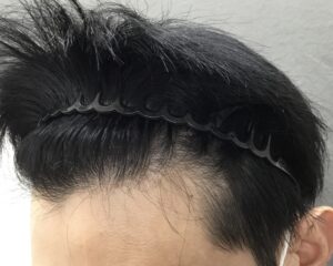 AGA治療前 47歳男性 生え際薄毛 京都院