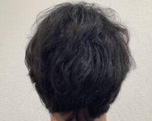 AGA治療後＿43歳男性＿後ろから見た頭頂部の薄毛が改善＿姫路院