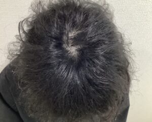 AGA治療後＿43歳男性＿頭頂部の薄毛が改善＿姫路院