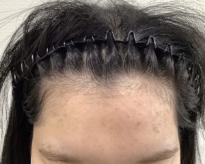 FAGA 22歳女性 生え際 治療後