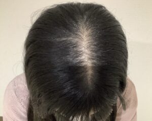 FAGA 22歳女性 頭頂部 治療後