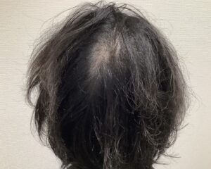 AGA治療前＿43歳男性＿後ろから見た頭頂部の薄毛＿姫路院