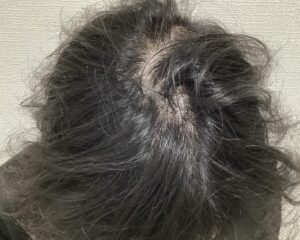 AGA治療前＿43歳男性＿頭頂部の薄毛＿姫路院