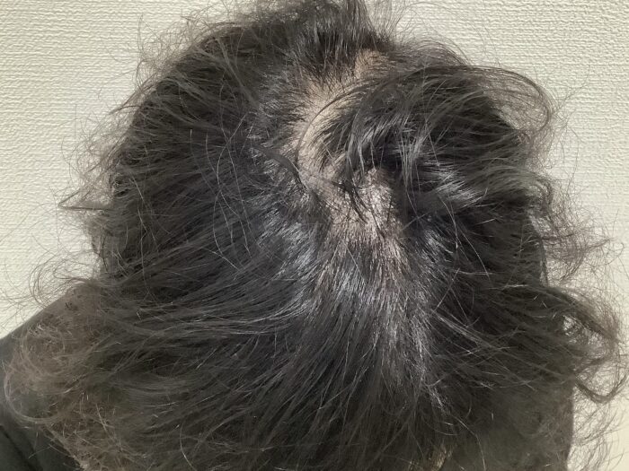 【43歳男性】頭頂部の薄毛がAGA治療で改善｜姫路院