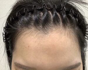 FAGA 22歳女性 生え際 治療前