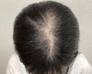 FAGA 22歳女性 頭頂部 治療前