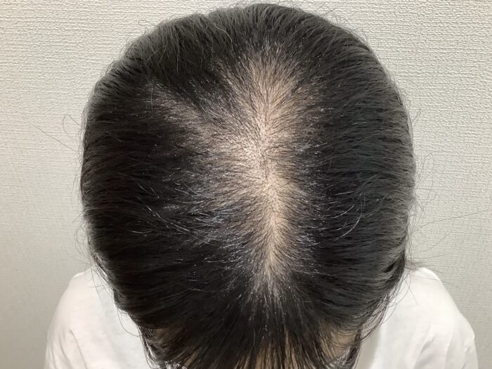 【22歳女性】広範囲に広がった分け目の薄毛がFAGA治療で改善｜姫路院