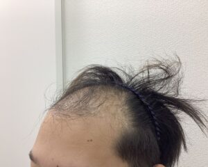 AGA治療前　32歳男性　前頭・頭頂部薄毛　新潟院