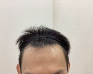 AGA治療前 35歳男性 生え際の薄毛 新潟院