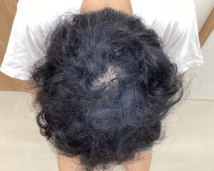 AGA治療10ヵ月経過　38歳男性　頭頂部　横浜院