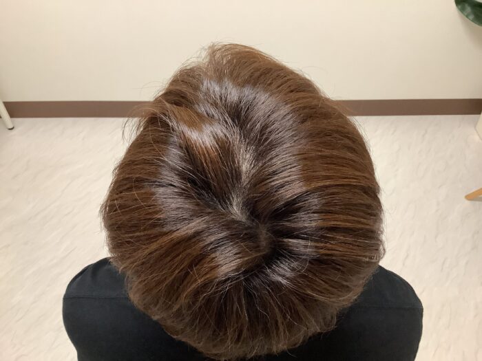 AGA治療開始4ヶ月経過 46歳男性 頭頂部薄毛 鹿児島院