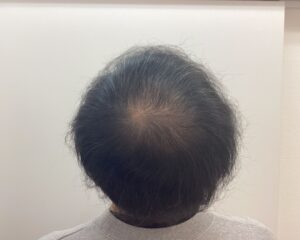 AGA治療前　47歳男性　生え際・頭頂部薄毛　新潟院