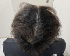 AGA治療前　29歳男性　生え際・頭頂部薄毛　岡山院