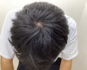 AGA治療9ヵ月経過　27歳男性　頭頂部　横浜院