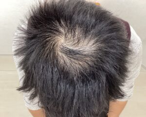 AGA治療前　43歳男性　頭頂部薄毛　横浜院