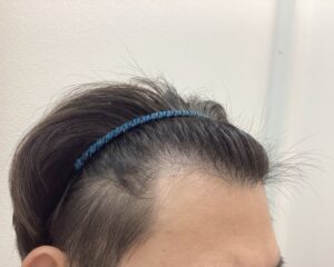 AGA治療前 29歳男性 前頭・頭頂部薄毛 新潟院