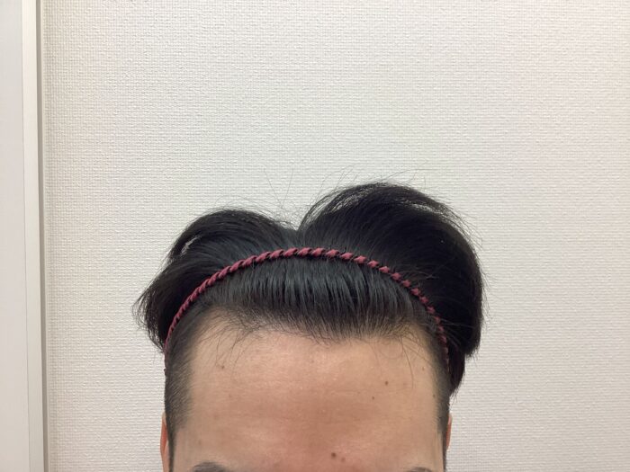 【25歳男性】生え際の薄毛がAGA治療で改善｜新潟院