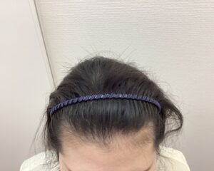 AGA治療前　24歳女性　生え際・分け目薄毛　新潟院