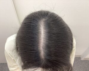 AGA治療前　24歳女性　生え際・分け目薄毛　新潟院