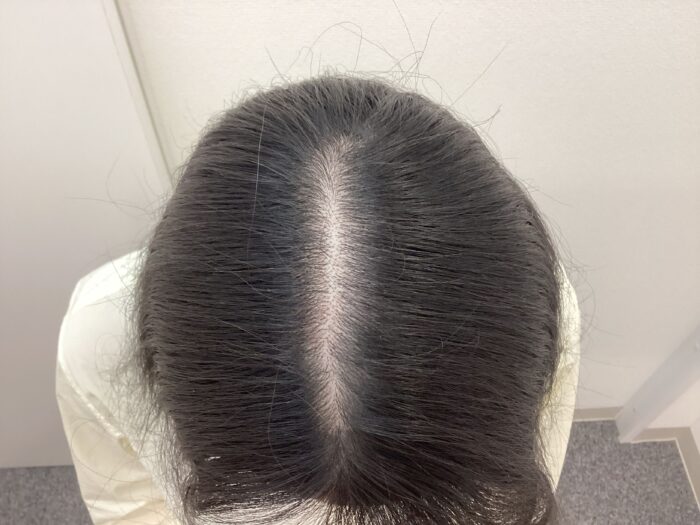 【24歳女性】生え際・分け目の薄毛がFAGA治療で改善｜新潟院