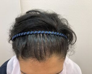 AGA治療前　42歳女性　側頭部・頭頂部薄毛　新潟院
