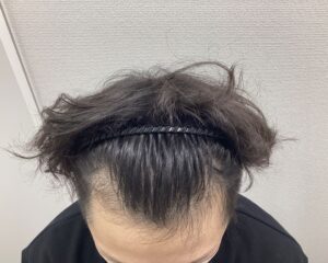 AGA治療前　31歳男性　生え際薄毛　新潟院