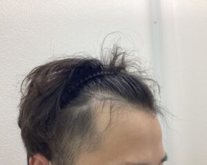AGA治療前　31歳男性　生え際薄毛　新潟院