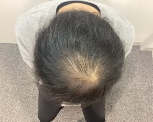 AGA治療前　47歳男性　生え際・頭頂部薄毛　新潟院