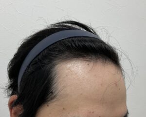 AGA治療9ヵ月後　29歳男性　生え際・頭頂部薄毛　岡山院