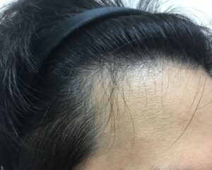 AGA治療前＿22歳男性＿生え際の薄毛＿大阪梅田院