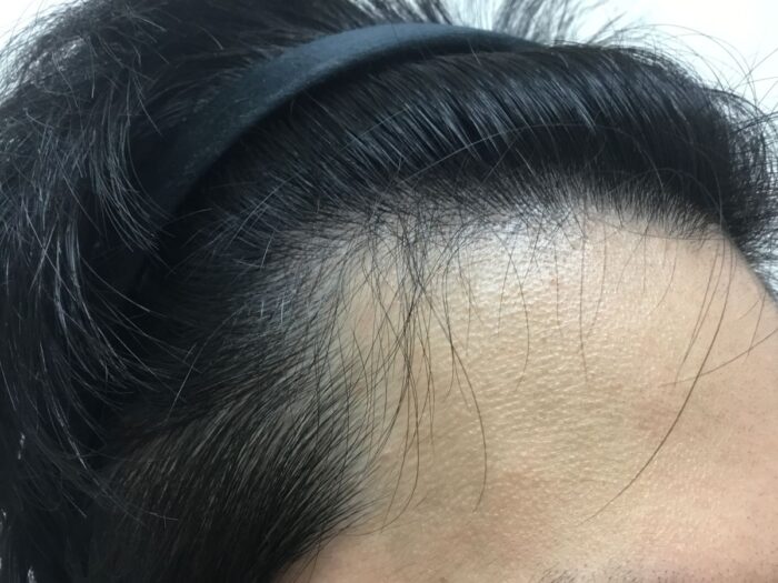 【22歳男性】生え際の薄毛がAGA治療で改善｜大阪梅田院