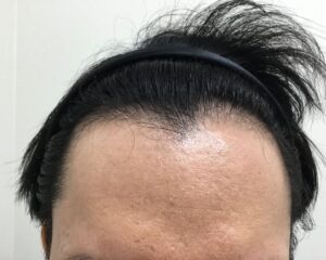 AGA治療前＿41歳男性＿生え際と頭頂部の薄毛＿大阪梅田院