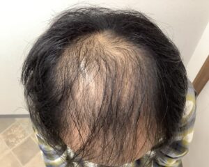 AGA治療前＿41歳男性＿生え際と頭頂部の薄毛＿広島院