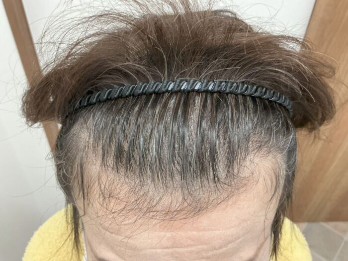 【69歳女性】頭部全体の薄毛がFAGA治療で改善｜広島院