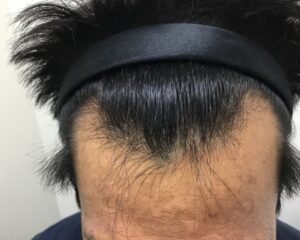 AGA治療前＿40歳男性＿生え際と頭頂部の薄毛＿大阪梅田院