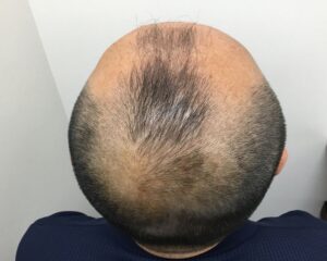 AGA治療前＿46歳男性＿生え際と頭頂部の薄毛＿大阪梅田院