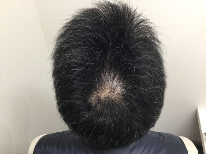 【49歳男性】頭頂部の薄毛がAGA治療で改善｜大阪梅田院