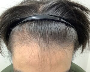 AGA治療前＿30歳男性＿生え際と頭頂部の薄毛＿広島院