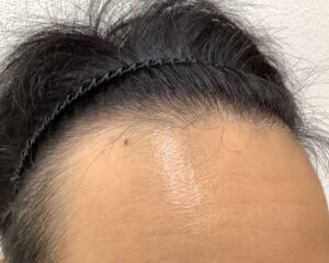 AGA治療前＿23歳男性＿生え際と頭頂部の薄毛＿広島院