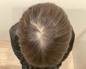 FAGA治療前＿37歳女性＿頭頂部と生え際の薄毛＿広島院
