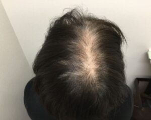 FAGA治療前＿50歳女性＿生え際・頭頂部の薄毛＿広島院