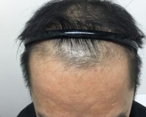 AGA治療前_53歳男性_生え際と頭頂部の薄毛_大阪梅田院