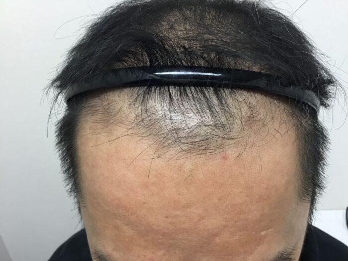 【53歳男性】生え際と頭頂部の薄毛がAGA治療で改善｜大阪梅田院