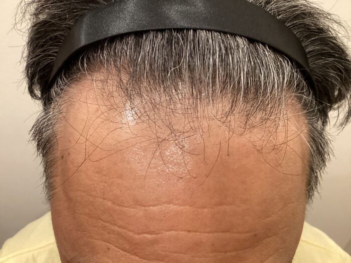 AGA治療前_54歳男性_生え際の薄毛_広島院