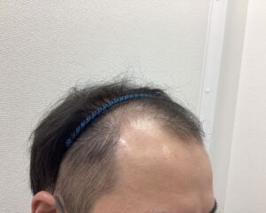 AGA治療前　30歳男性　前頭・頭頂部薄毛　新潟院