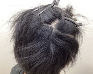 多発型の円形脱毛症治療6ヵ月経過　20歳男性　側頭部　横浜院