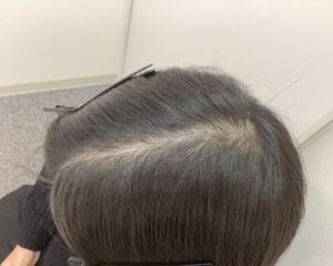 AGA治療前 29歳男性 前頭・頭頂部薄毛 新潟院
